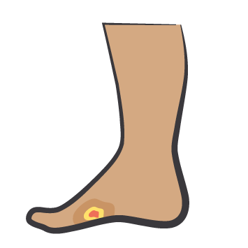 Diabetic foot ulcer icon