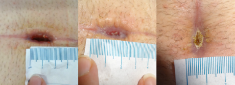 Dehisced surgical wound